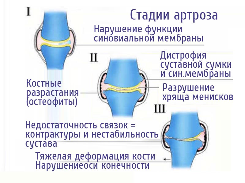 Деформирующий остеоартроз клиническая картина